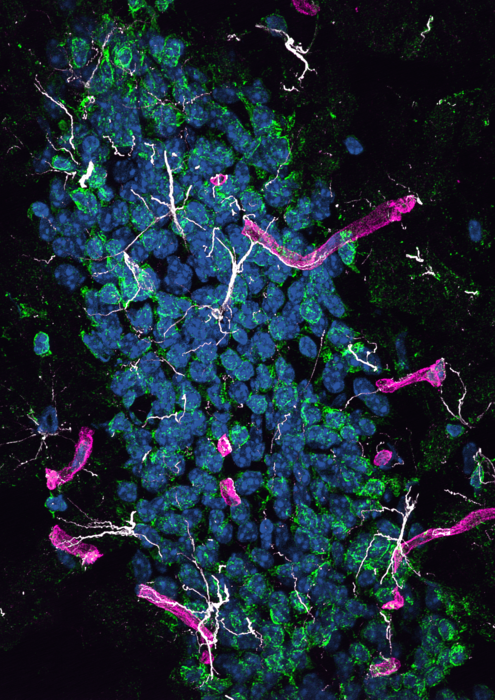 来自肝脏的蛋白质可能导致大脑中的阿尔茨海默病