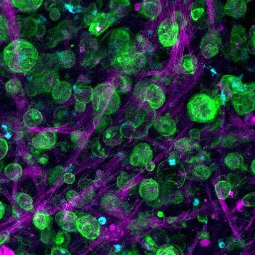 实验室培养的肿瘤模型可以改善胰腺癌的治疗