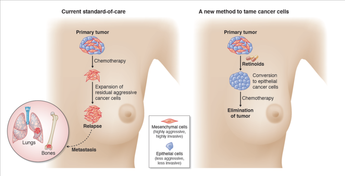 新加坡团队发现控制侵袭性乳腺癌的新策略并开始临床试验