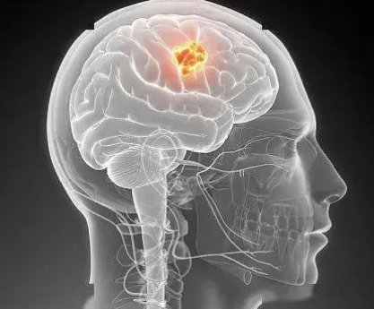 凝胶增强了胶质母细胞瘤手术治疗大脑中CAR-T免疫疗法的益处