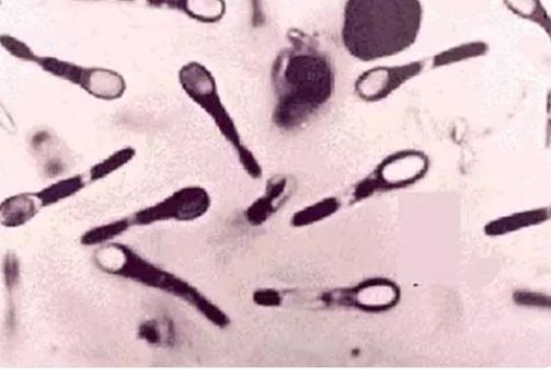 BIDMC研究人员证实高毒素水平与更严重的艰难梭菌感染有关