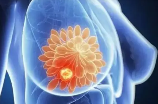 乳腺癌研究收集数据以帮助女性了解手术后的健康结果