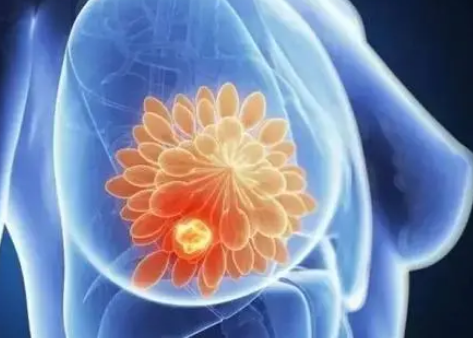 干预消除了早期乳腺癌和肺癌生存率的黑白差距