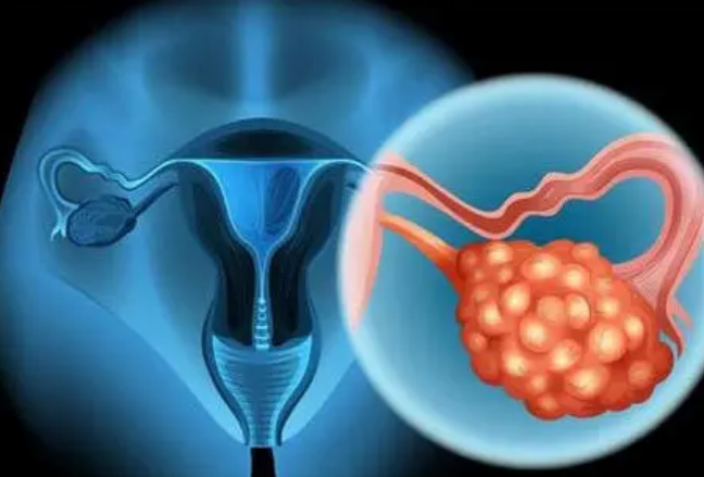 研究指出改善卵巢癌治疗的新方法