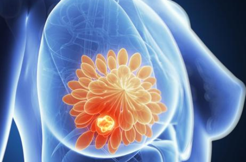 研究性治疗吡罗替尼联合化疗可能会改善HER2阳性乳腺癌患者的预后