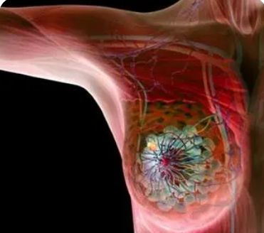 重新利用的药物在三阴性乳腺癌的联合治疗中显示出改善的结果