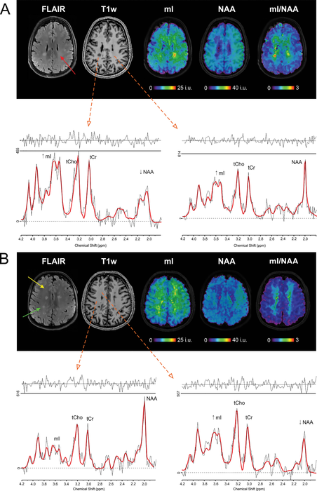 新的 MRI 技术更早地检测到 MS 的大脑变化