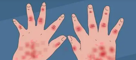 研究人员开发了新工具来帮助更好地监测狼疮