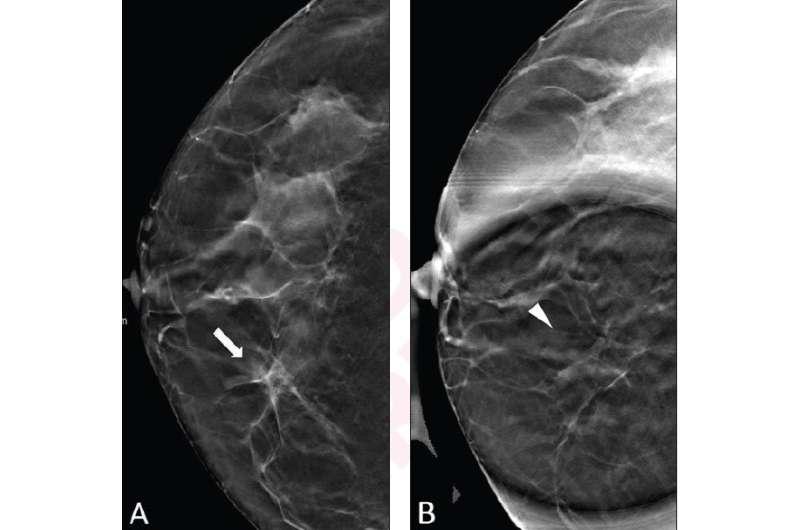 2月17日数字乳房断层合成点压缩澄清了模棱两可的 DBT 发现