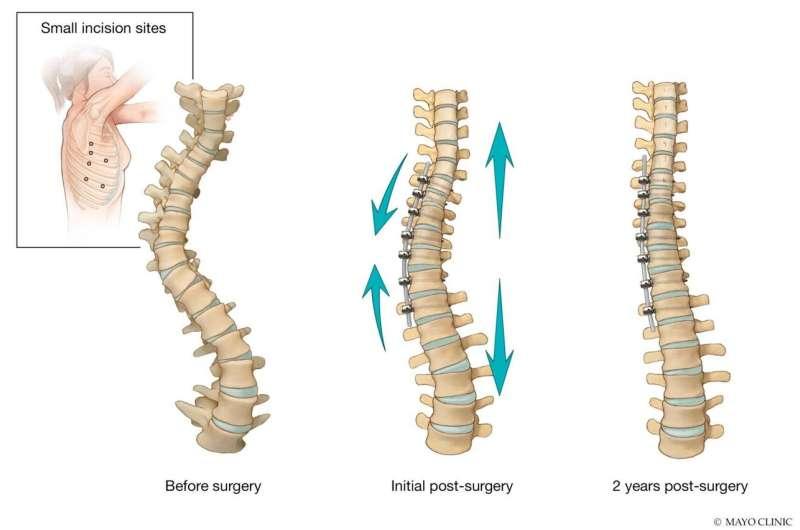 2月22日治疗儿童脊柱侧弯的另一种选择