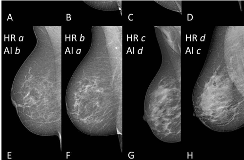 AI 提供准确的乳房密度分类