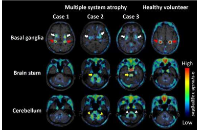 研究人员可视化患有神经退行性疾病的活体患者的 α-突触核蛋白病理学