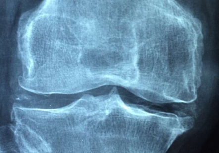 膝关节置换后的虚拟物理治疗带来相似的结果