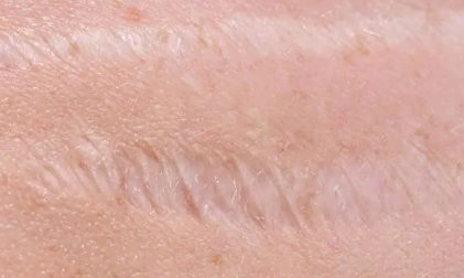 科学家找到防止皮肤疤痕形成的新方法