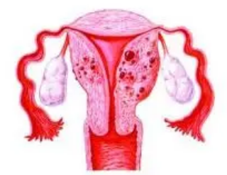 子宫内膜异位症的详细分子特征可以改善对数百万女性的护理