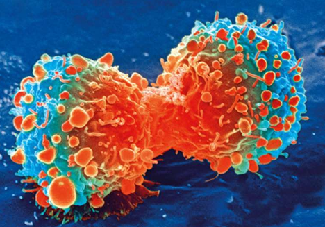 小细胞肺癌研究总结报告指出进展与挑战