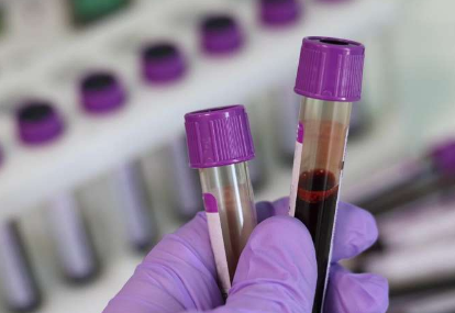 简单的血液测试可以帮助预测帕金森病的进展