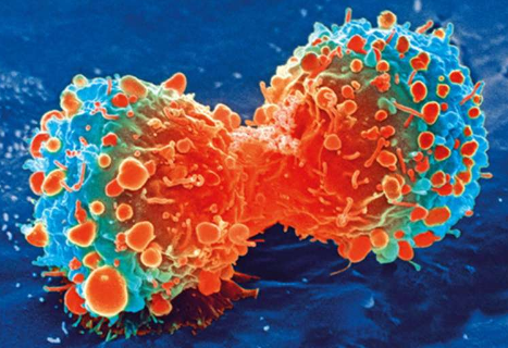 癌细胞改变蛋白质生产机制以加速转移