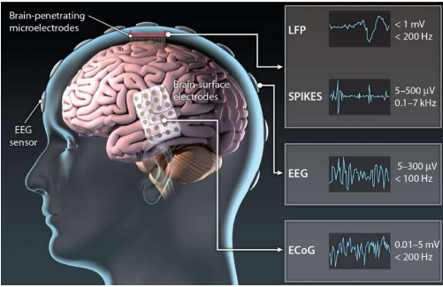 神经假体使用大脑活动来解码语音