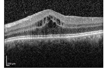 发现眼内皮质类固醇最适合治疗慢性炎症性眼病的并发症