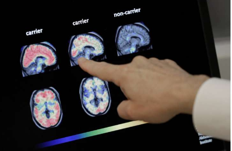 阿尔茨海默病脑部扫描的医疗保险覆盖范围存在问题