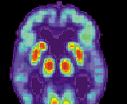 人工智能工具有望更快 更准确地诊断阿尔茨海默病
