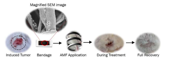 一种带有磁性纳米纤维的绷带 可通过热量杀死皮肤癌细胞