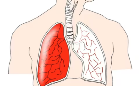 研究：痰的颜色可以预测肺病患者的预后
