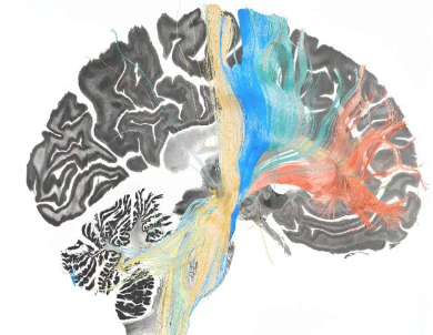 研究人员利用深部脑刺激来绘制四种脑部疾病的治疗目标