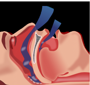 研究发现植入装置成功治疗中枢性睡眠呼吸暂停