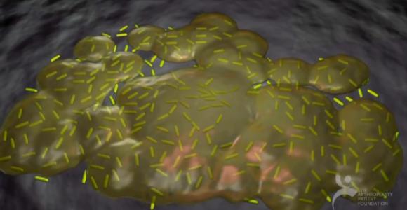 微泡有助于对抗危险的生物膜