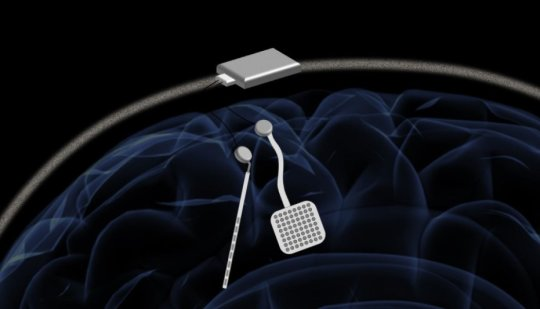 无线“大脑起搏器”可以为神经系统疾病提供新的治疗方法