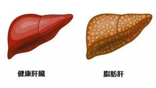 母乳喂养超过六个月的母亲 发生脂肪肝的可能性降低