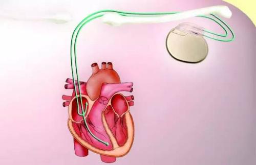 微小的心脏起搏器减少婴儿心脏手术的侵入性 降低运营成本和时间