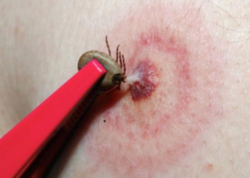英国蜱传莱姆病病例可能比之前的估计值高3倍