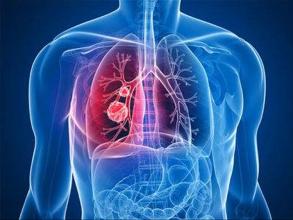 自身抗体检测和CT成像可以降低肺癌死亡率