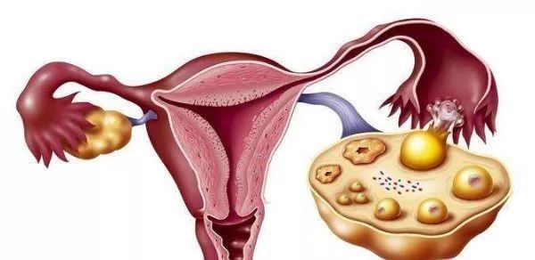 新技术可以检测微小的卵巢肿瘤