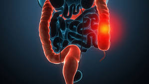 TAU和Ichilov研究人员开发了家族性腺瘤性息肉病的治疗方法