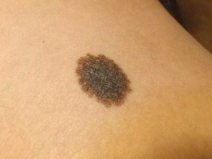 黑色素瘤是最严重的皮肤癌类型 它会侵入附近的组织并扩散到全身