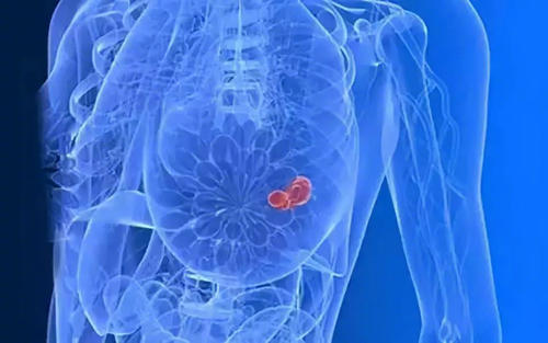 免疫疗法可导致乳腺癌患者完全缓解症状