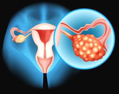 实验室研究提供了关于卵巢癌如何形成的新假设