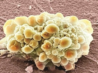 免疫系统细胞促进胶质母细胞瘤的侵袭能力