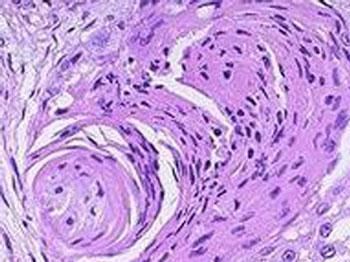 Mayo科学家在临床前研究中逆转纤维化