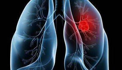 研究确定了肺癌的潜在标志物