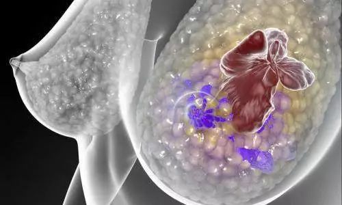 详细的乳腺癌图谱揭示了遗传变化如何塑造肿瘤景观