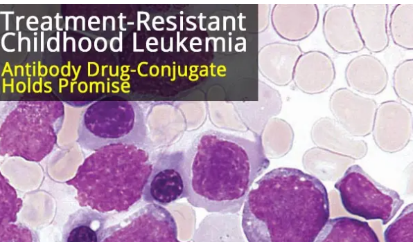 抗体药物结合靶向治疗抗性儿童白血病