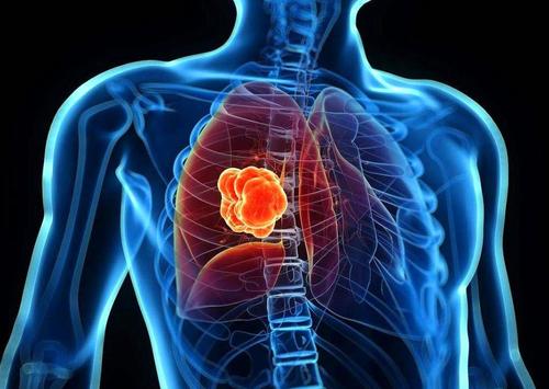 联合疗法可以帮助治疗致命的肺癌