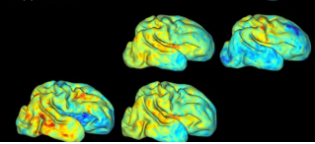 科学家3-D映射早产儿的大脑发育