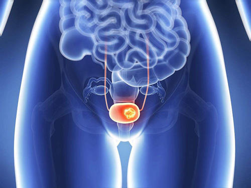 炭疽可能是抗击膀胱癌的下一个工具