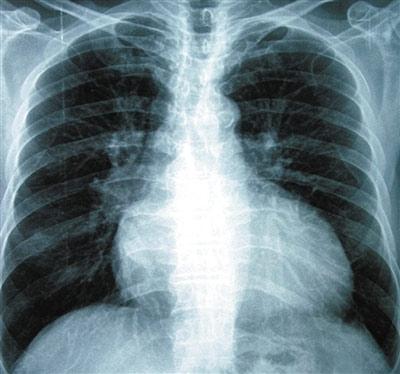 心胸影像学发表有关雾化的特别报告